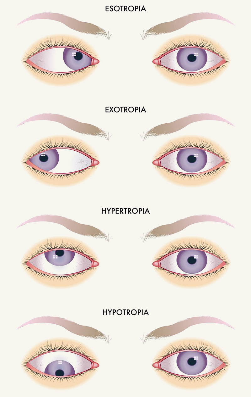 strabismus.jpg